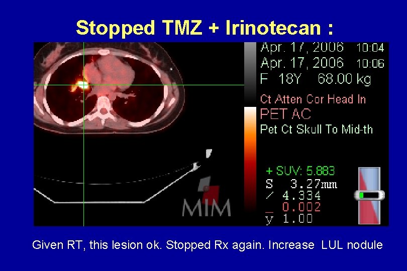 Stopped TMZ + Irinotecan : Relapse Given RT, this lesion ok. Stopped Rx again. Stopped TMZ + Irinotecan : Relapse Given RT, this lesion ok. Stopped Rx again.