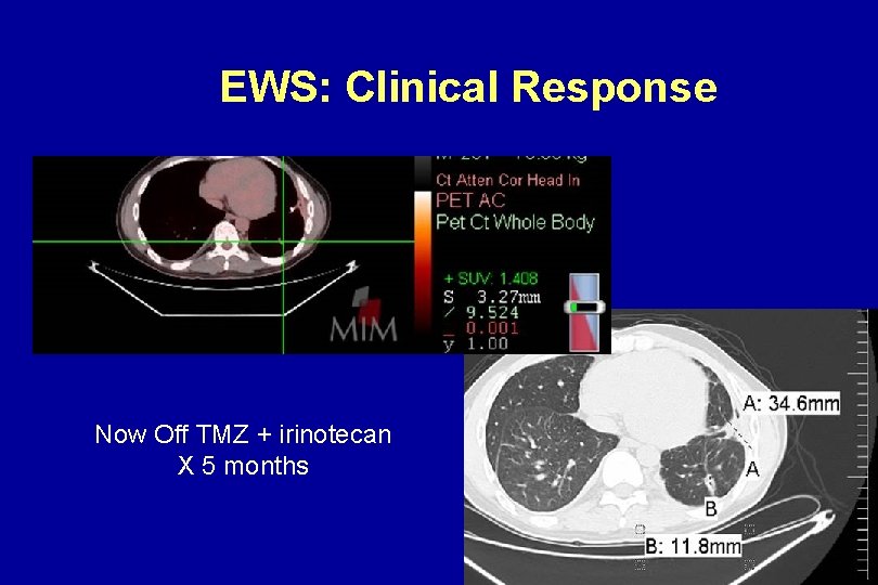 EWS: Clinical Response Now Off TMZ + irinotecan X 5 months EWS: Clinical Response Now Off TMZ + irinotecan X 5 months