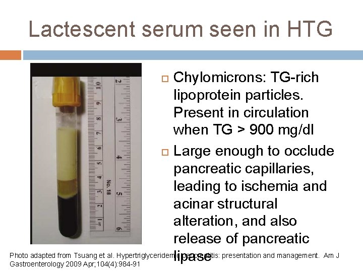 Lactescent serum seen in HTG Chylomicrons: TG-rich lipoprotein particles. Present in circulation when TG Lactescent serum seen in HTG Chylomicrons: TG-rich lipoprotein particles. Present in circulation when TG