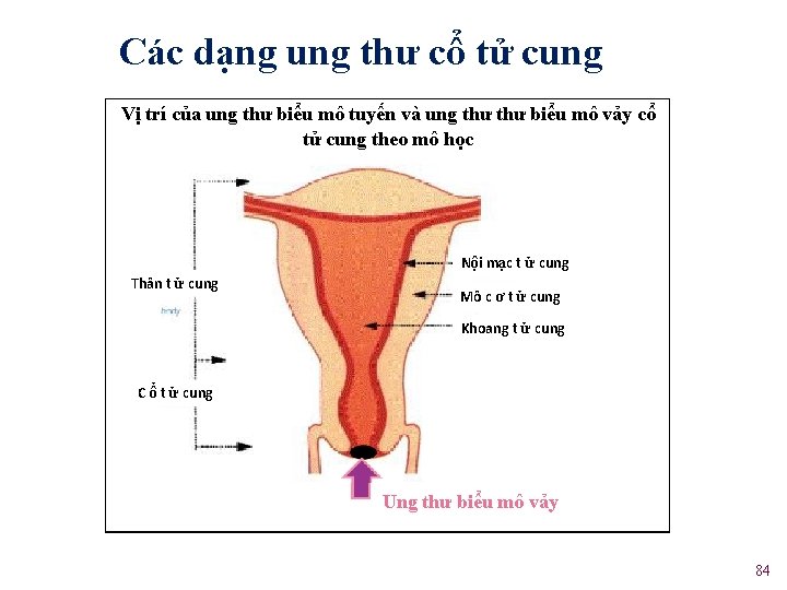 Các dạng ung thư cổ tử cung Vị trí của ung thư biểu mô