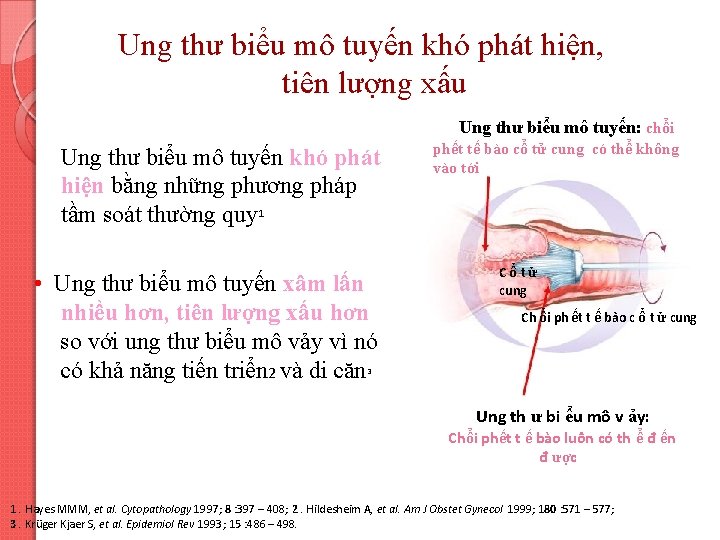Ung thư biểu mô tuyến khó phát hiện, tiên lượng xấu Ung thư biểu