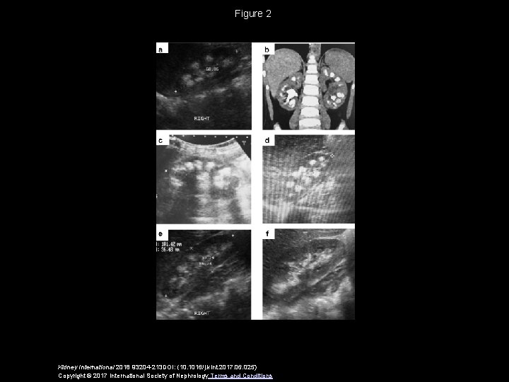 Figure 2 Kidney International 2018 93204 -213 DOI: (10. 1016/j. kint. 2017. 06. 025)