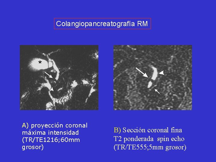 Colangiopancreatografía RM A) proyección coronal máxima intensidad (TR/TE 1216; 60 mm grosor) B) Sección