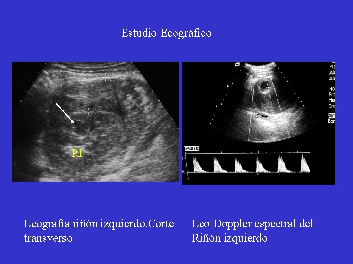 Estudio Ecográfico RI Ecografía riñón izquierdo. Corte transverso Eco Doppler espectral del Riñón izquierdo