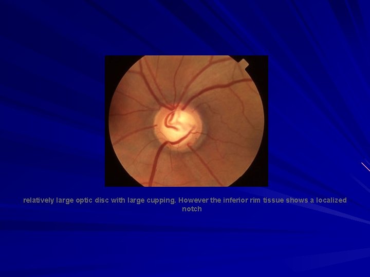 relatively large optic disc with large cupping. However the inferior rim tissue shows relatively large optic disc with large cupping. However the inferior rim tissue shows