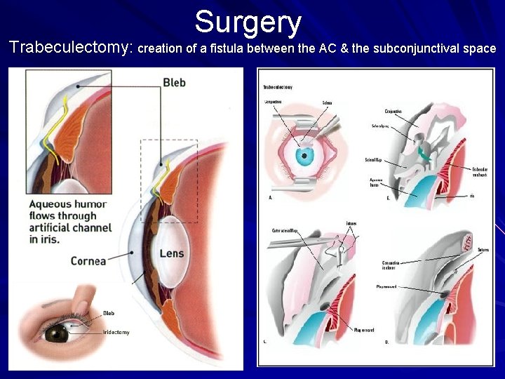 Surgery Trabeculectomy: creation of a fistula between the AC & the subconjunctival space Surgery Trabeculectomy: creation of a fistula between the AC & the subconjunctival space