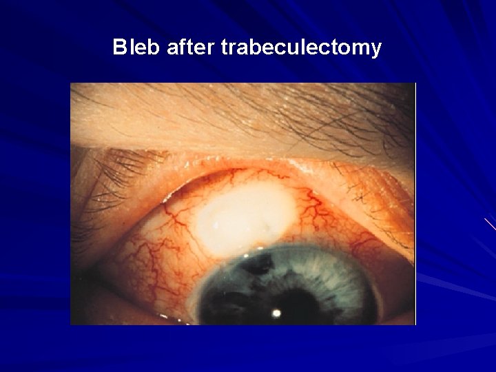 Bleb after trabeculectomy Bleb after trabeculectomy