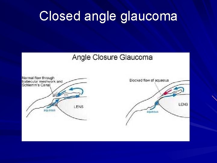 Closed angle glaucoma Closed angle glaucoma