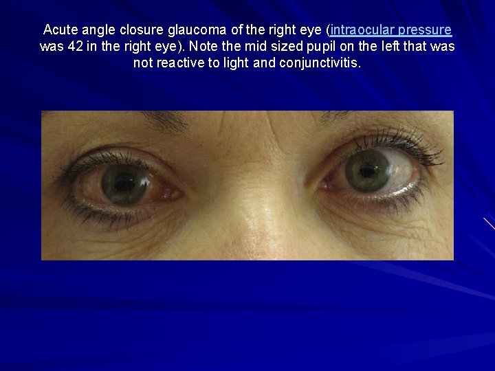 Acute angle closure glaucoma of the right eye (intraocular pressure was 42 in the Acute angle closure glaucoma of the right eye (intraocular pressure was 42 in the