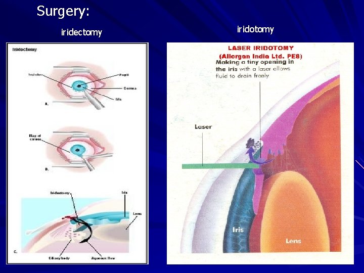 Surgery: iridectomy iridotomy Surgery: iridectomy iridotomy