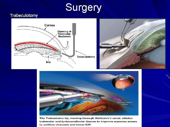 Trabeculotomy Surgery Trabeculotomy Surgery