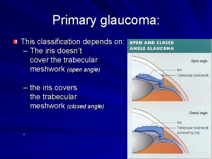 Primary glaucoma: This classification depends on: – The iris doesn’t cover the trabecular meshwork Primary glaucoma: This classification depends on: – The iris doesn’t cover the trabecular meshwork