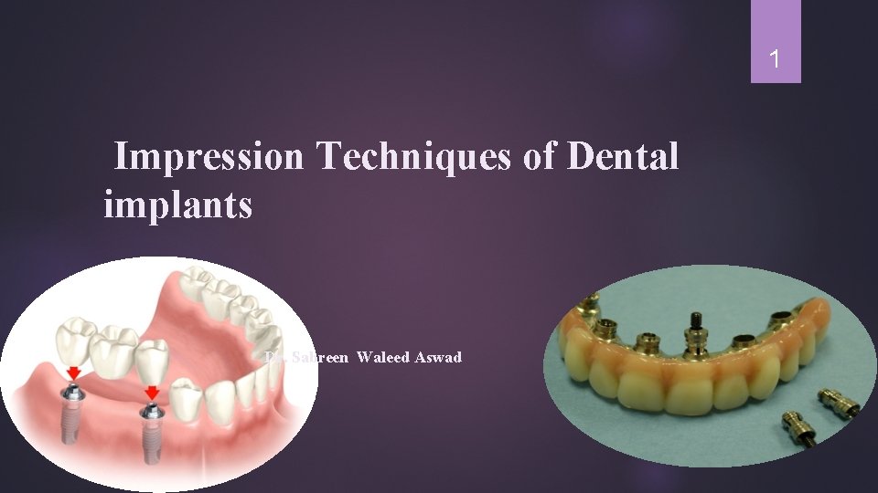 1 Impression Techniques of Dental implants Dr. Sabreen Waleed Aswad 