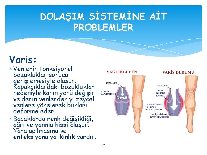 DOLAŞIM SİSTEMİNE AİT PROBLEMLER Varis: ∗ Venlerin fonksiyonel bozukluklar sonucu genişlemesiyle oluşur. Kapakçıklardaki bozukluklar