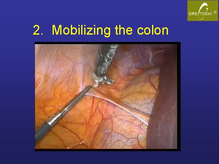 2. Mobilizing the colon 