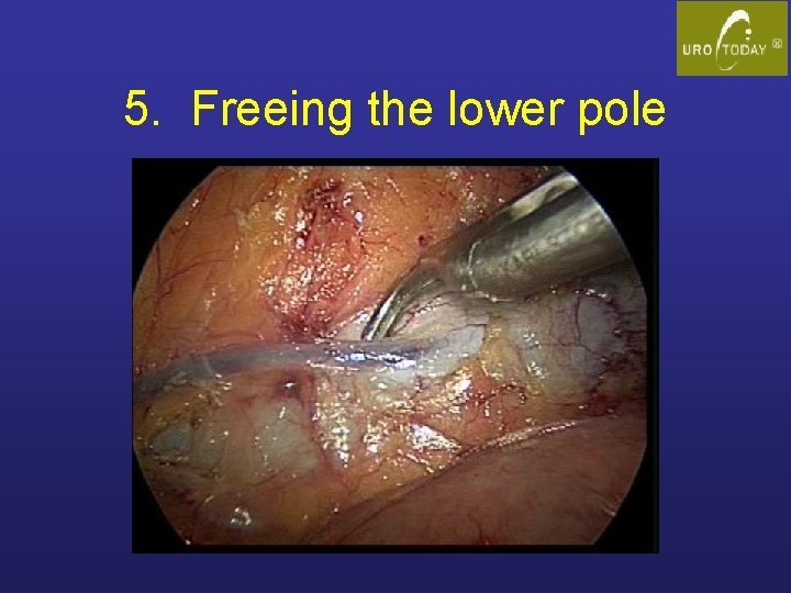 5. Freeing the lower pole 