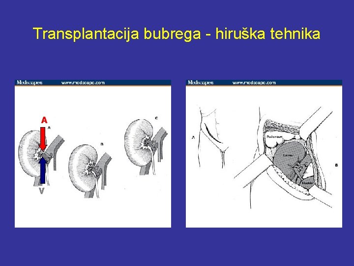 Transplantacija bubrega - hiruška tehnika A V 