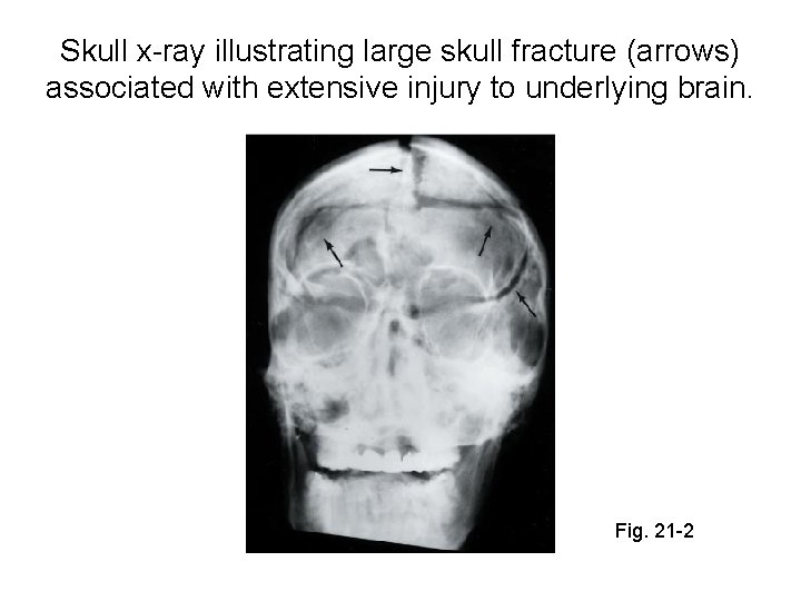 Skull x-ray illustrating large skull fracture (arrows) associated with extensive injury to underlying brain.