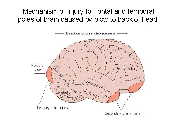Mechanism of injury to frontal and temporal poles of brain caused by blow to