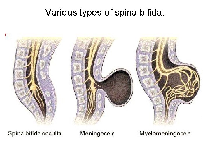 Various types of spina bifida. 
