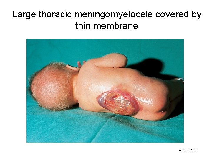 Large thoracic meningomyelocele covered by thin membrane Fig. 21 -6 