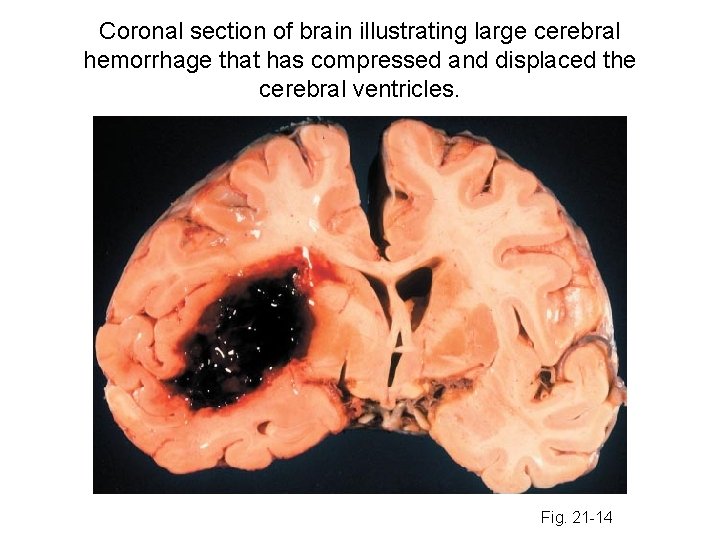 Coronal section of brain illustrating large cerebral hemorrhage that has compressed and displaced the