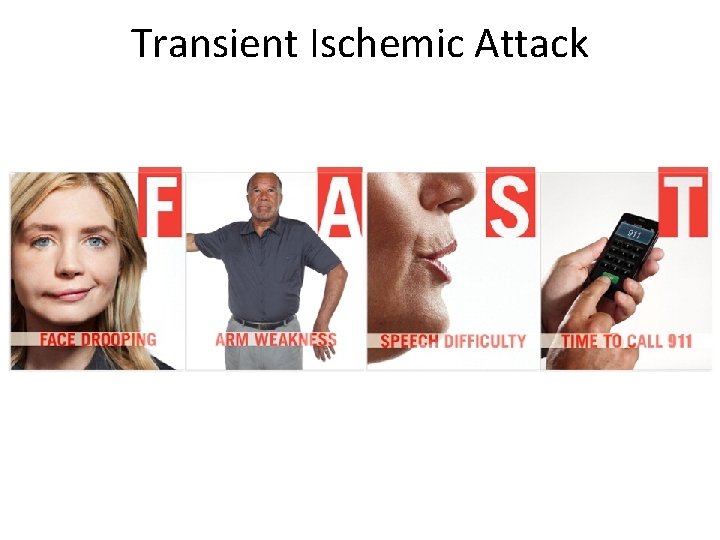 Transient Ischemic Attack 