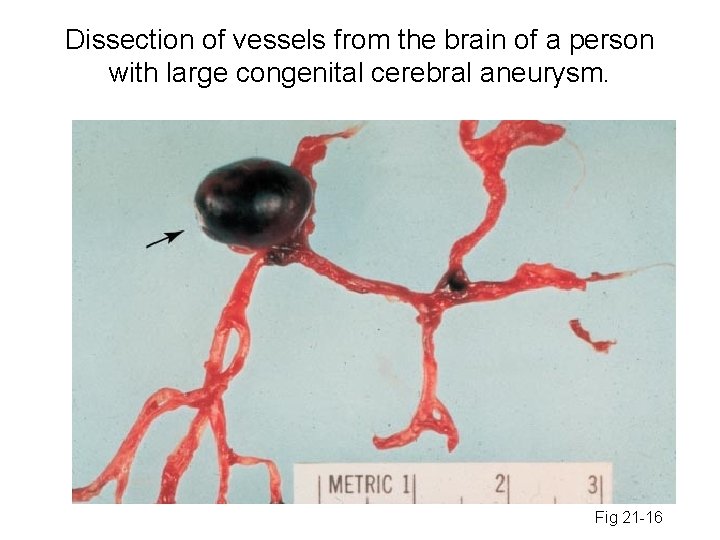 Dissection of vessels from the brain of a person with large congenital cerebral aneurysm.