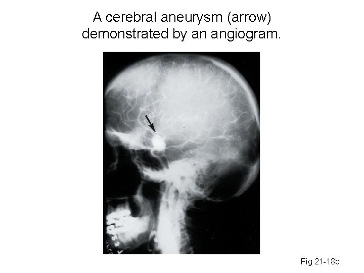 A cerebral aneurysm (arrow) demonstrated by an angiogram. Fig 21 -18 b 