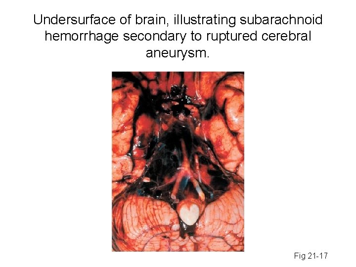 Undersurface of brain, illustrating subarachnoid hemorrhage secondary to ruptured cerebral aneurysm. Fig 21 -17