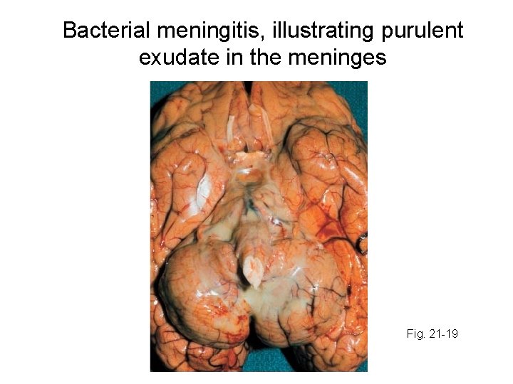 Bacterial meningitis, illustrating purulent exudate in the meninges Fig. 21 -19 