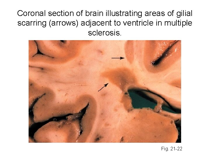 Coronal section of brain illustrating areas of gilial scarring (arrows) adjacent to ventricle in