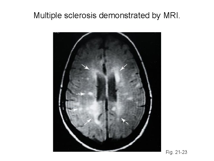 Multiple sclerosis demonstrated by MRI. Fig. 21 -23 