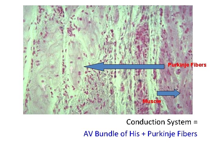 Purkinje Fibers Muscle Conduction System = AV Bundle of His + Purkinje Fibers 