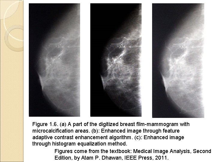 Figure 1. 6. (a) A part of the digitized breast film-mammogram with microcalcification areas.