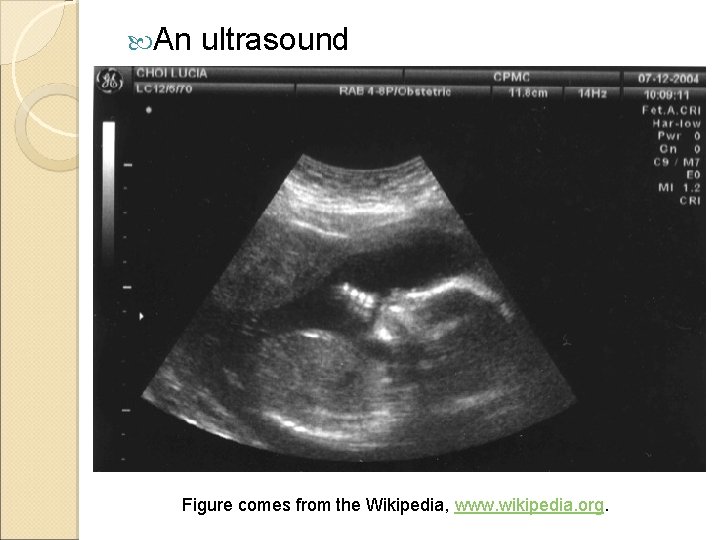  An ultrasound Figure comes from the Wikipedia, www. wikipedia. org. 