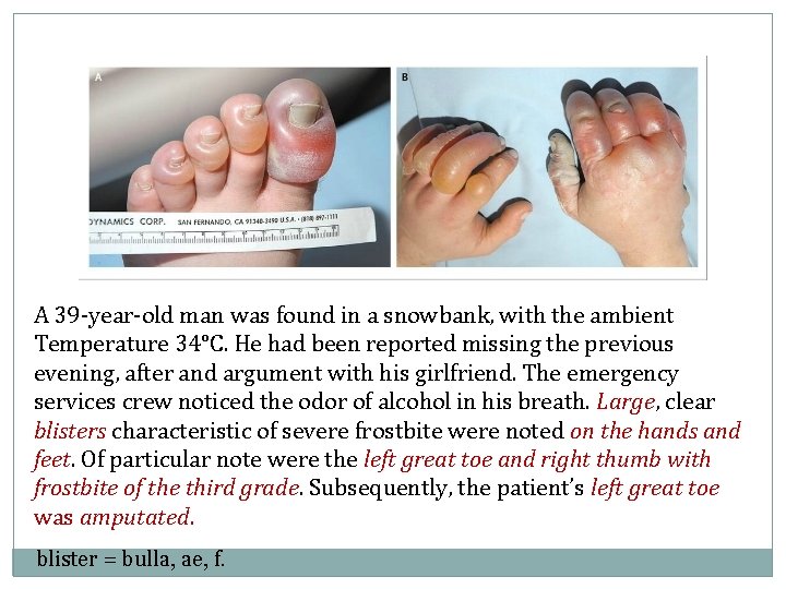 A 39 -year-old man was found in a snowbank, with the ambient Temperature 34°C.