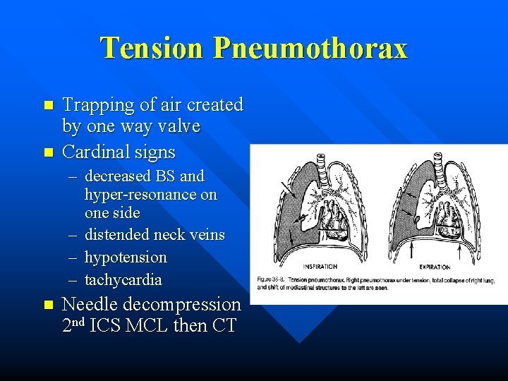 Tension Pneumothorax n n Trapping of air created by one way valve Cardinal signs