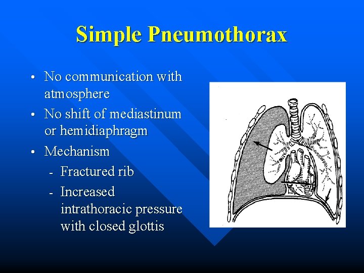 Simple Pneumothorax No communication with atmosphere • No shift of mediastinum or hemidiaphragm •