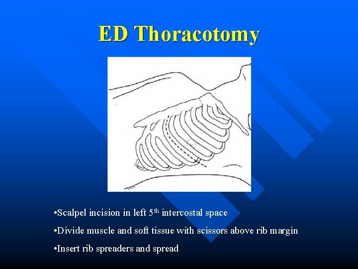 ED Thoracotomy • Scalpel incision in left 5 th intercostal space • Divide muscle