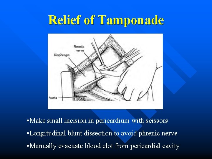 Relief of Tamponade • Make small incision in pericardium with scissors • Longitudinal blunt