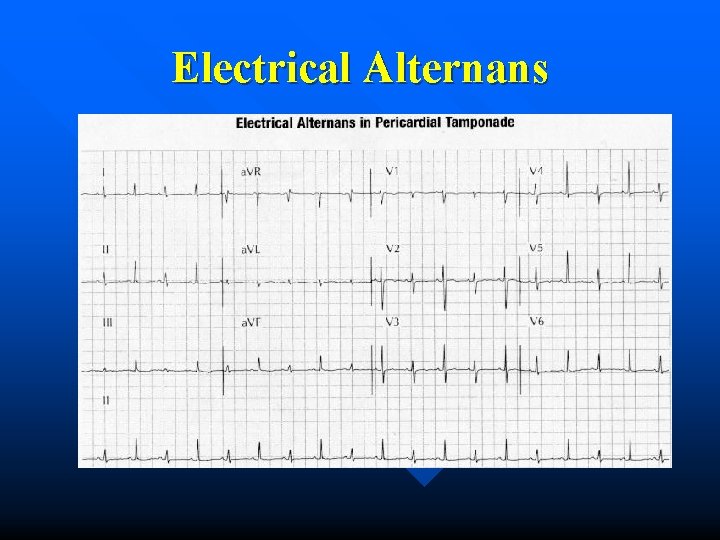 Electrical Alternans 