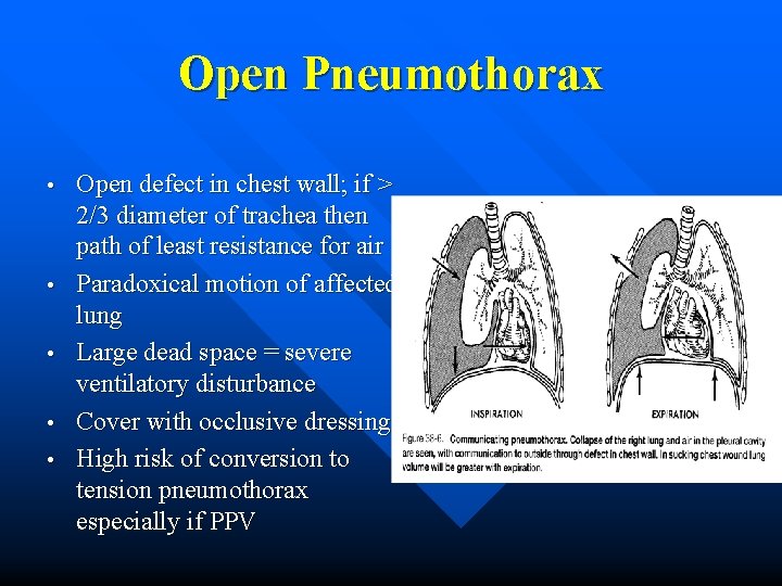 Open Pneumothorax • • • Open defect in chest wall; if > 2/3 diameter