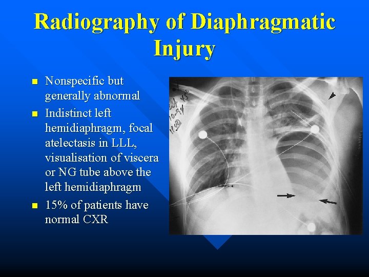Radiography of Diaphragmatic Injury n n n Nonspecific but generally abnormal Indistinct left hemidiaphragm,