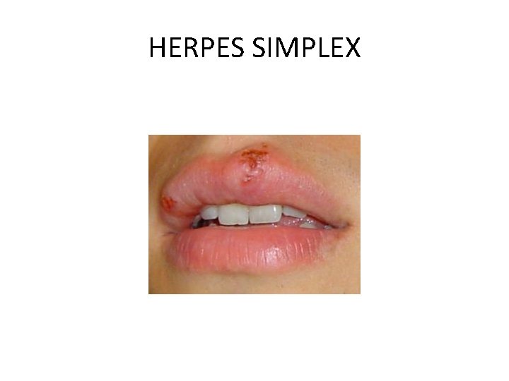 HERPES SIMPLEX 