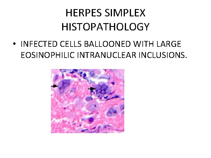 HERPES SIMPLEX HISTOPATHOLOGY • INFECTED CELLS BALLOONED WITH LARGE EOSINOPHILIC INTRANUCLEAR INCLUSIONS. 