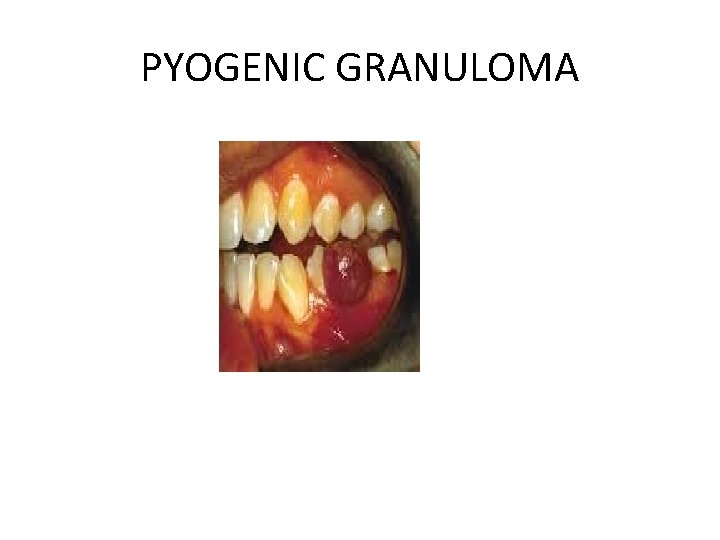 PYOGENIC GRANULOMA 
