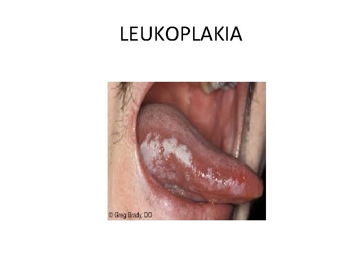 LEUKOPLAKIA 