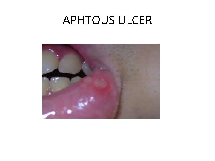 APHTOUS ULCER 