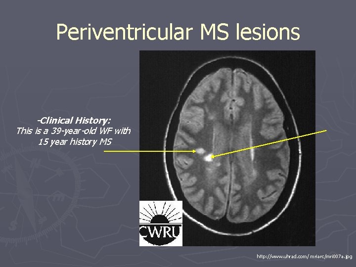 Periventricular MS lesions -Clinical History: This is a 39 -year-old WF with 15 year